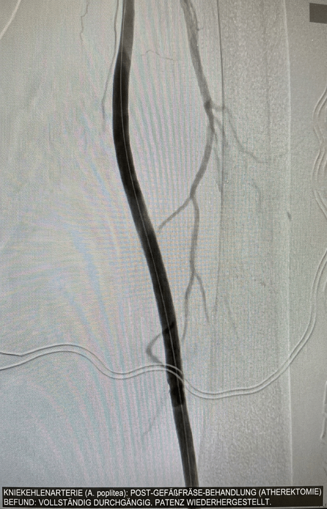 Der gleiche Patient, nachdem die verkalkte Schlagader mit einer Gefäßfräse wieder eröffnet wurde